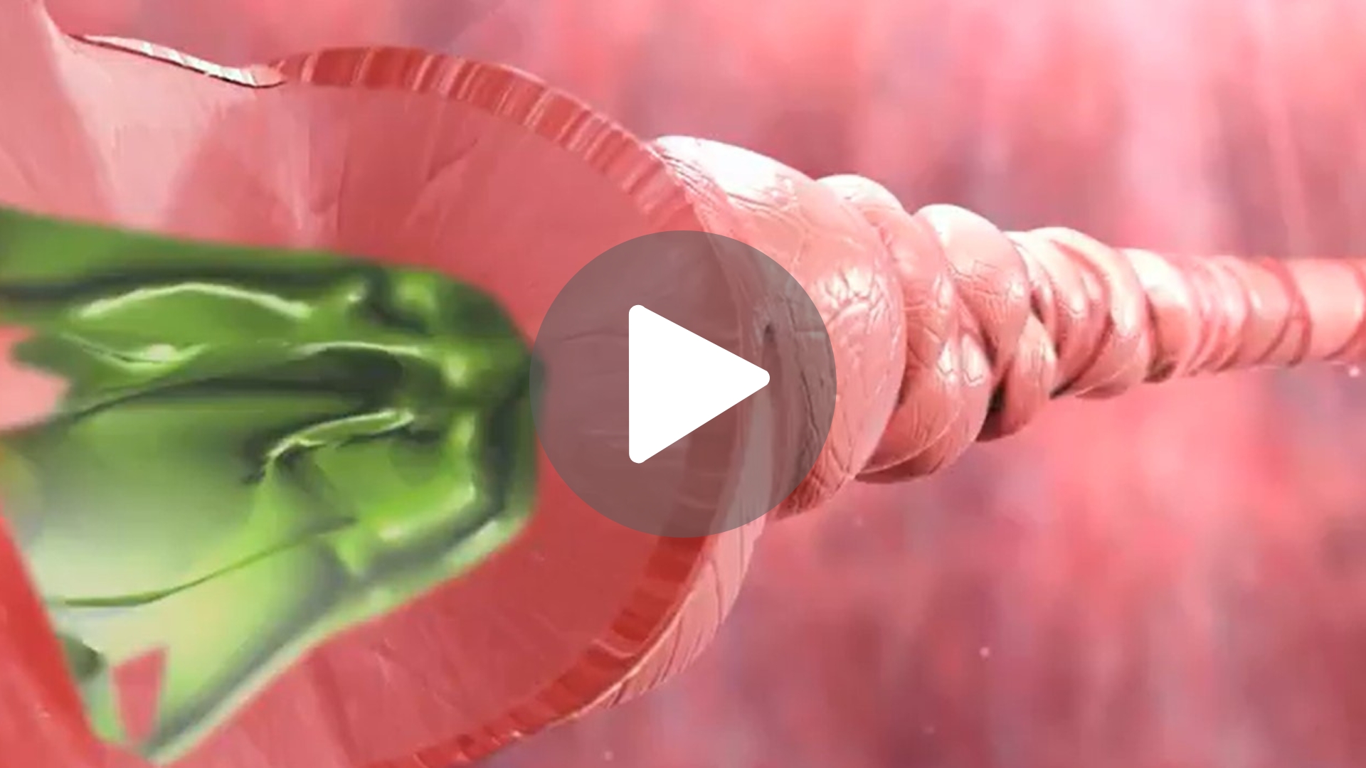 Airways with Asthma (3D animation) Thumbnail Airways with Asthma (3D animation)